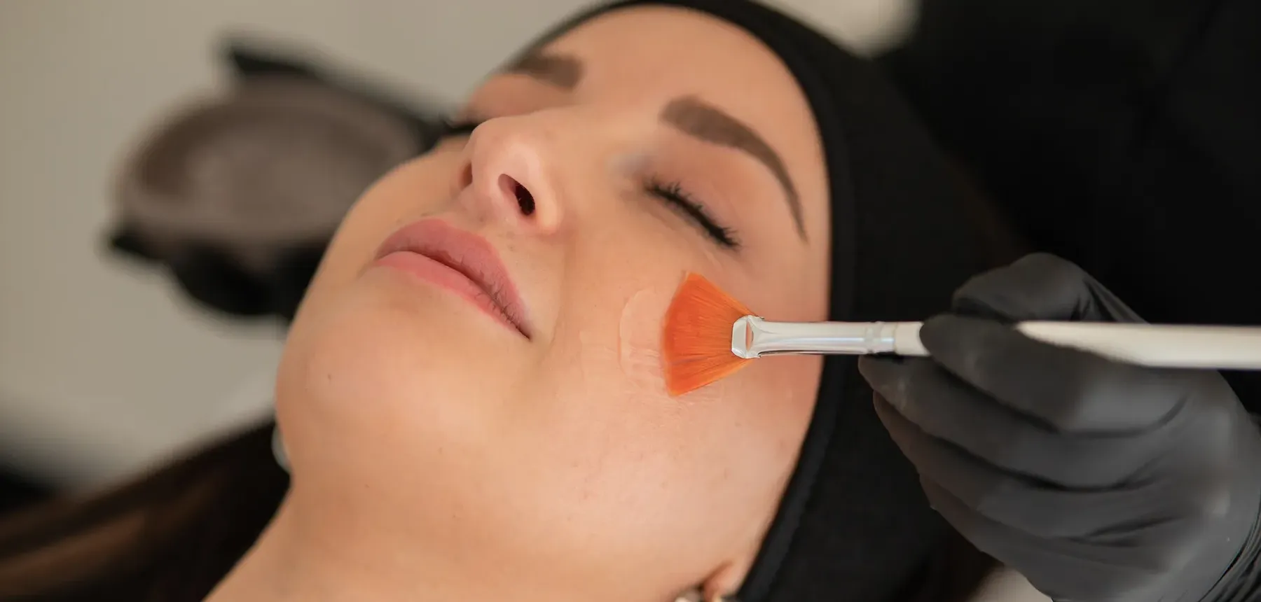 Säurepeeling Bad Sassendorf
